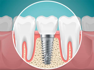 ¿Qué hay de todo en 4 implantes dentales?